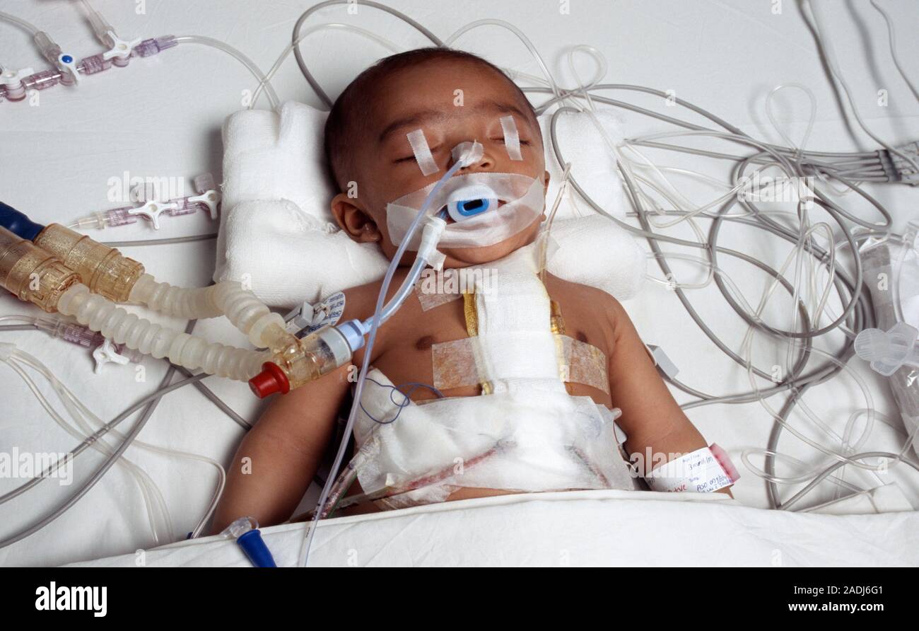 Heart surgery patient. Baby in intensive care after open heart surgery