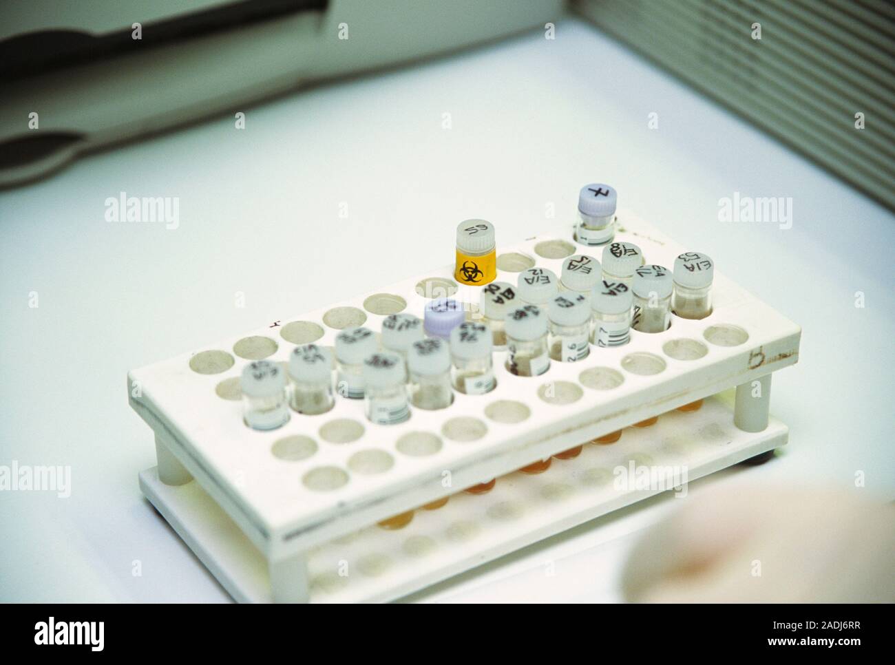 Test for a thyroid disorder. Vials being used in a test to diagnose a