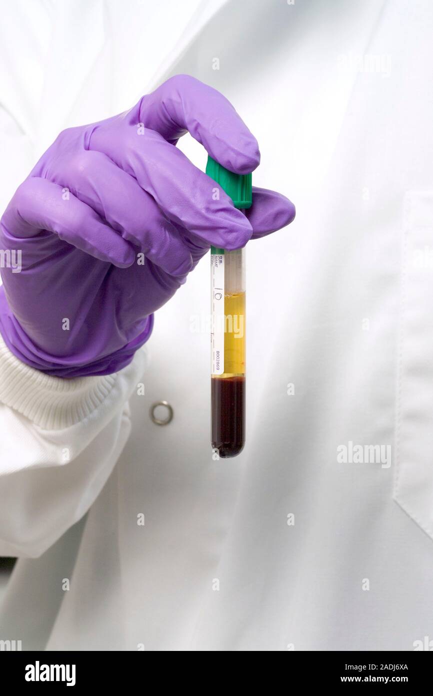 Centrifuged blood. Technician holding a vacutainer tube filled with ...