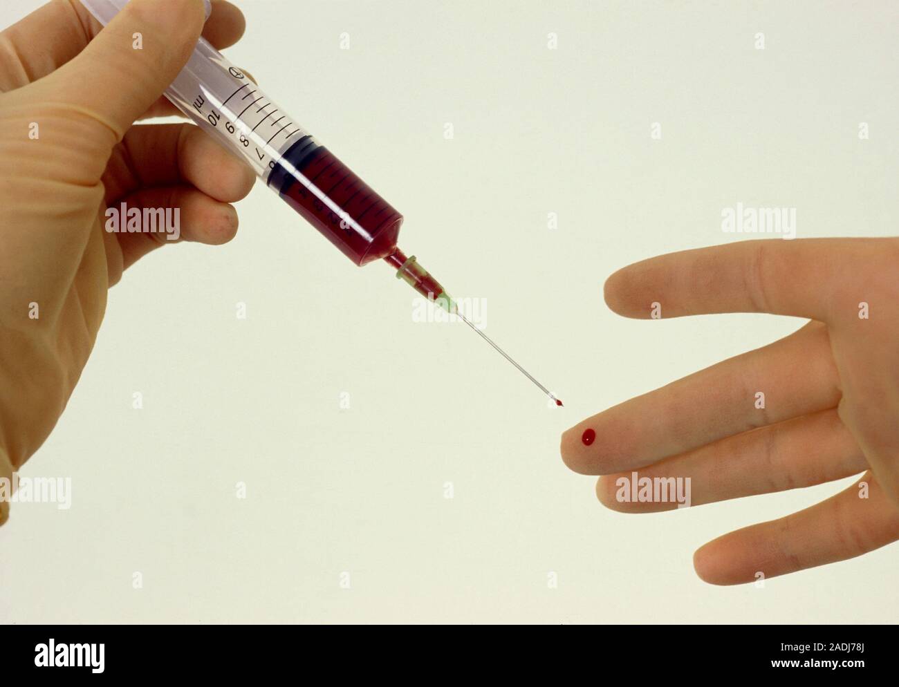 Blood sampling infection. Gloved hand pricked on the finger by the