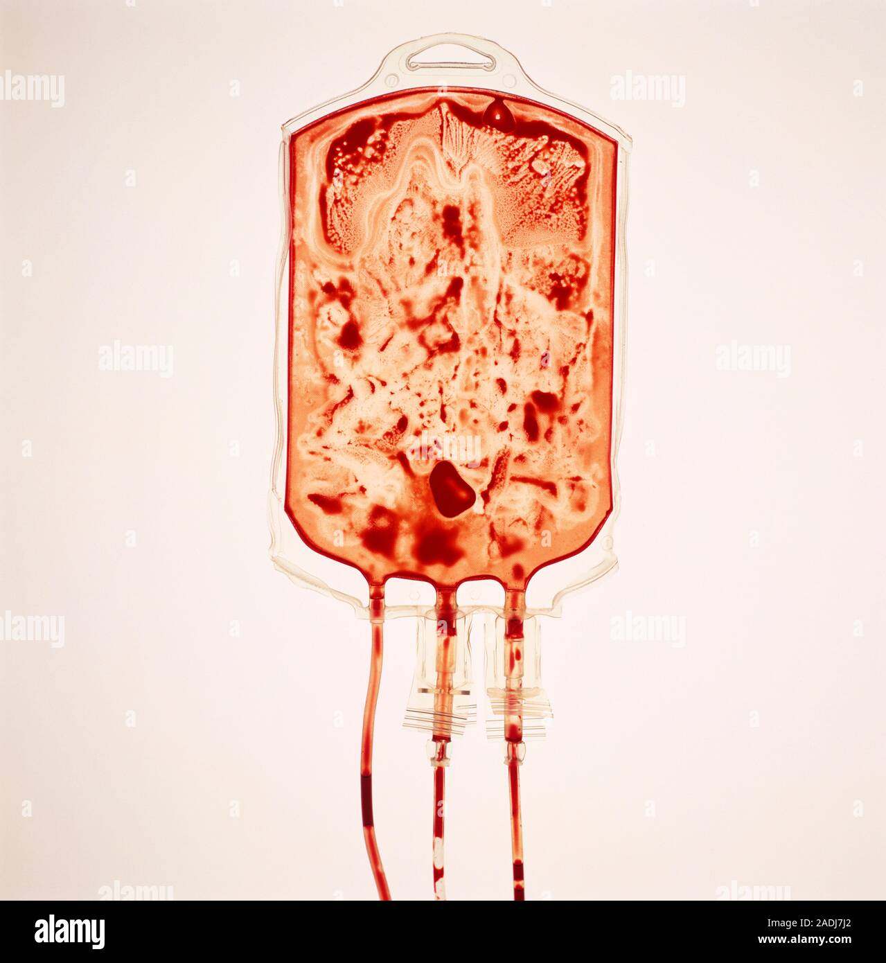 Empty blood bag. Bag of blood emptied after a transfusion. The bag was