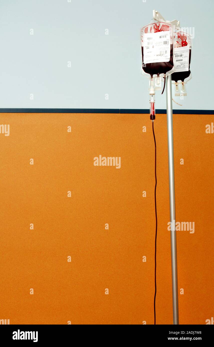 Blood transfusion stand. Bloodfilled tubing and blood bags attached to