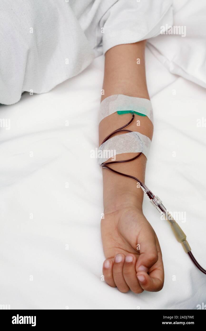 Paediatric blood transfusion. Bloodfilled tubing attached to a young boy's arm during a blood