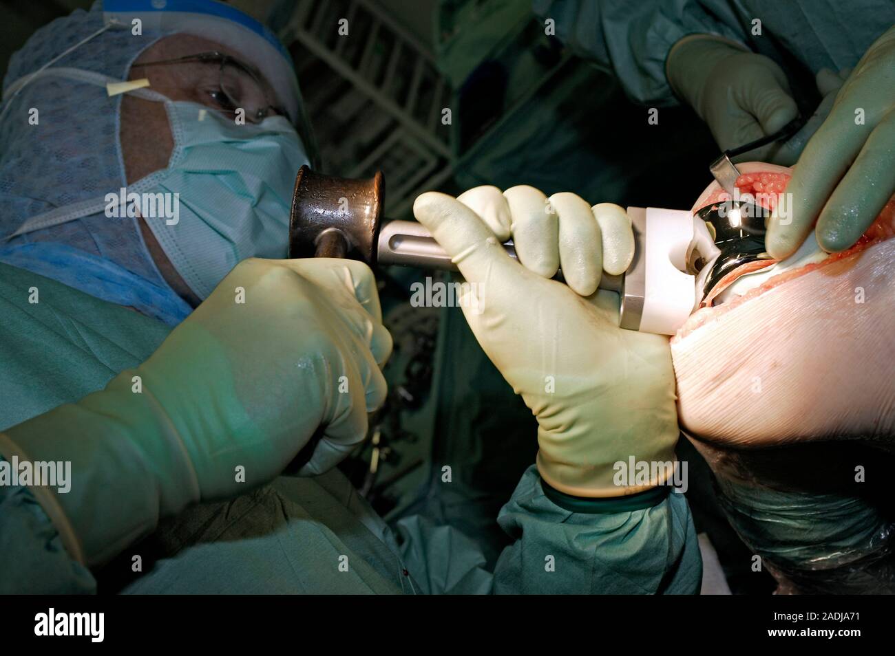 MODEL RELEASED. Knee replacement surgery. Image 6 of 10. Surgeons