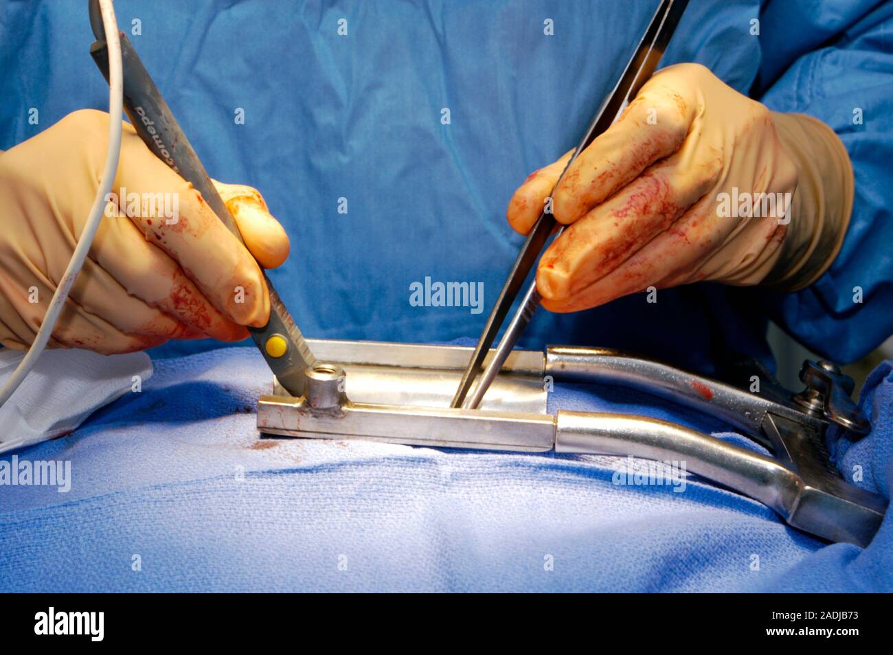 Heart surgery. Image 4 of 24. Surgeon using a cautery knife to cut open