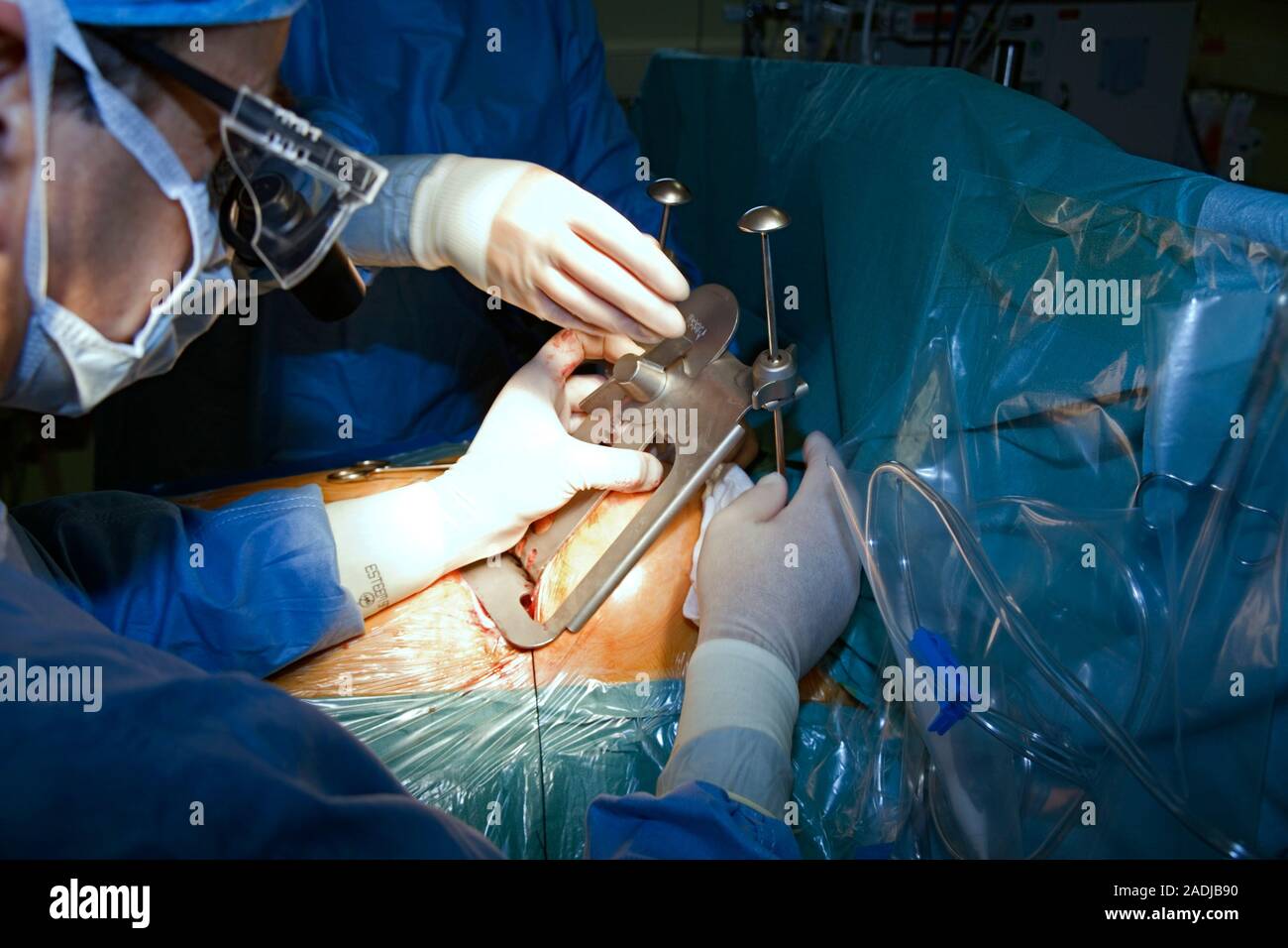 Heart bypass surgery. Surgeons about to open a patient's chest with rib ...