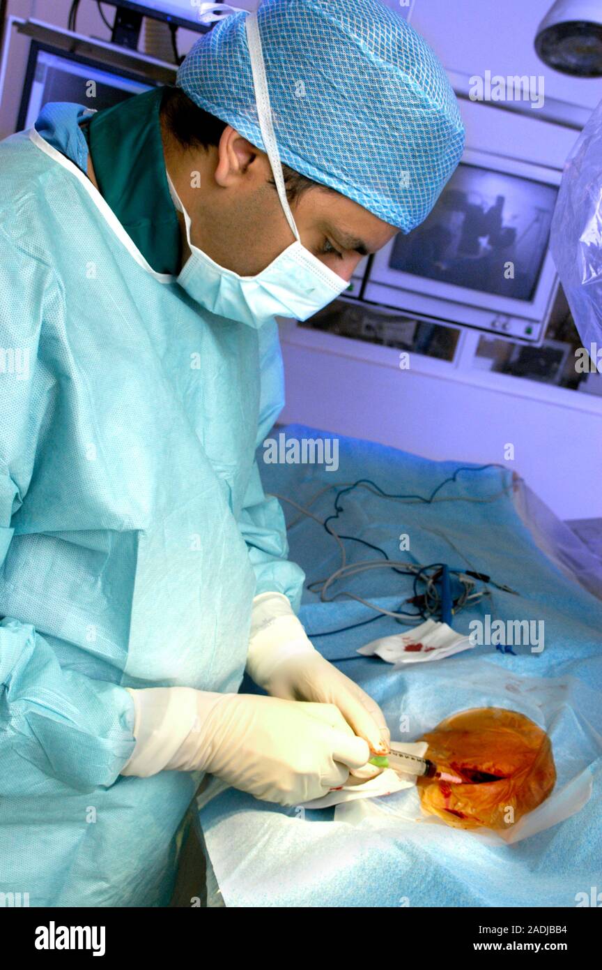 MODEL RELEASED. Heart pacemaker surgery. Image 5 of 9. Surgeon draining ...