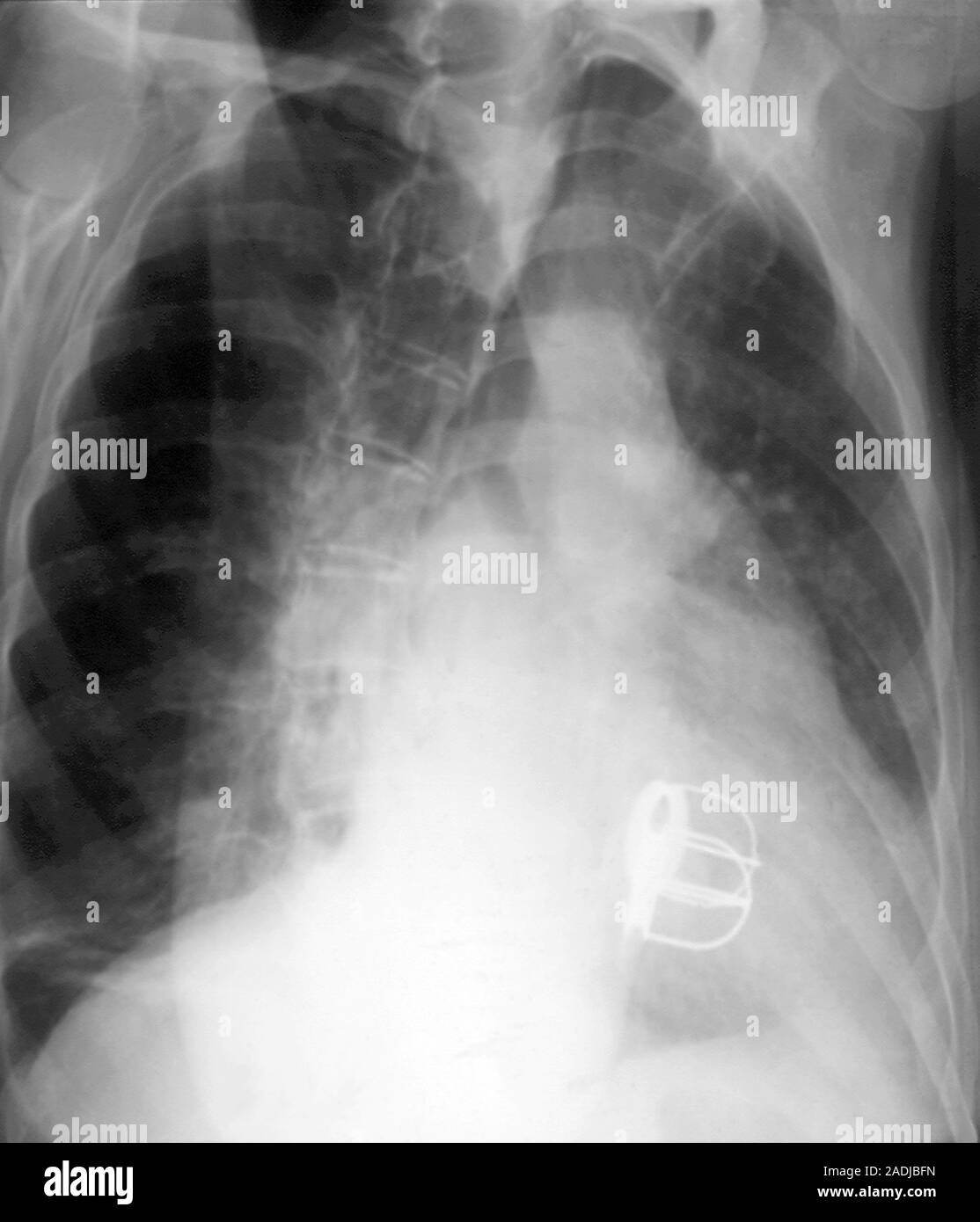 Prosthetic heart valves. Xray, taken diagonally from the right, of a