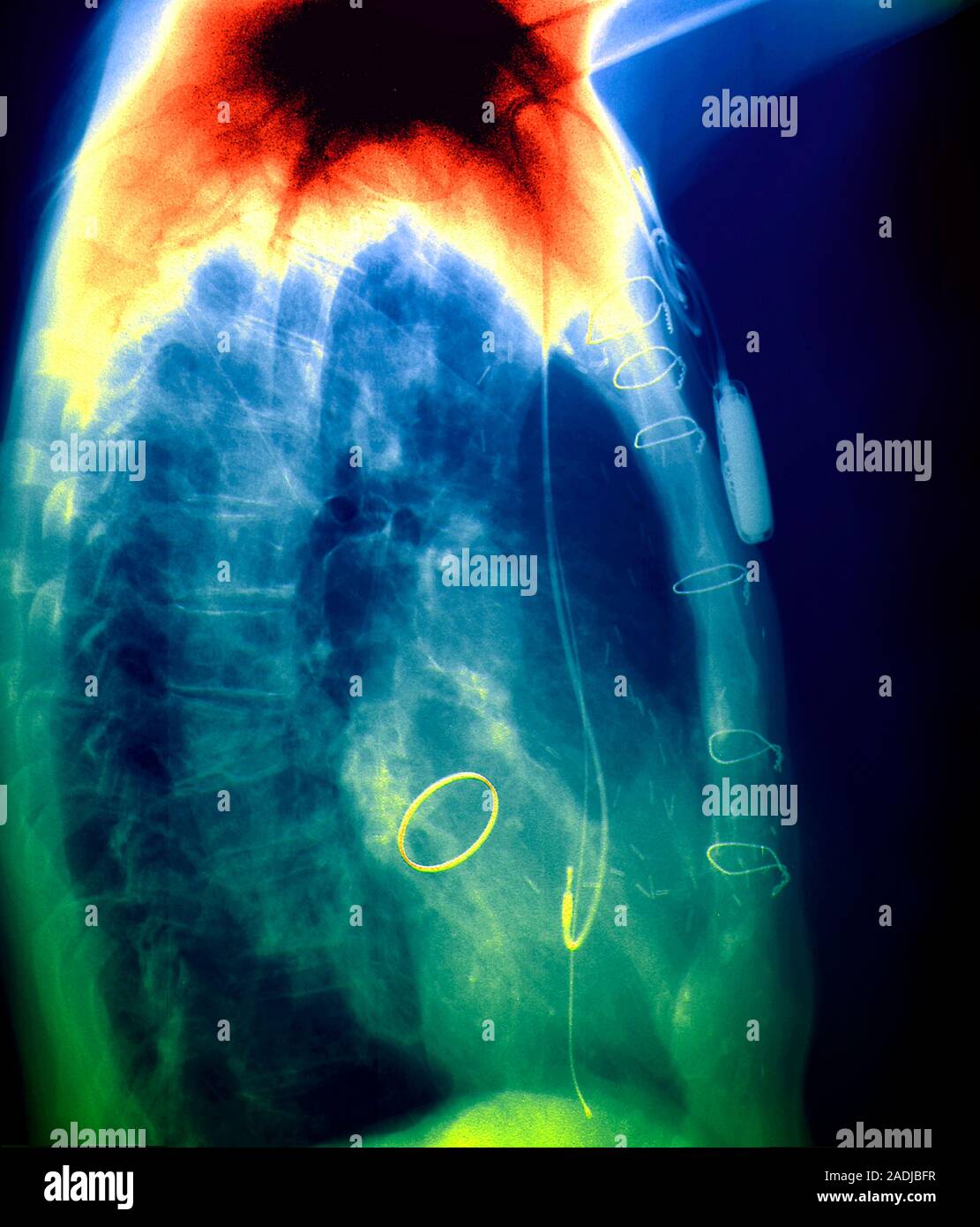 Prosthetic heart valve and pacemaker. Coloured X ray of a sideview of a 72yearold woman's