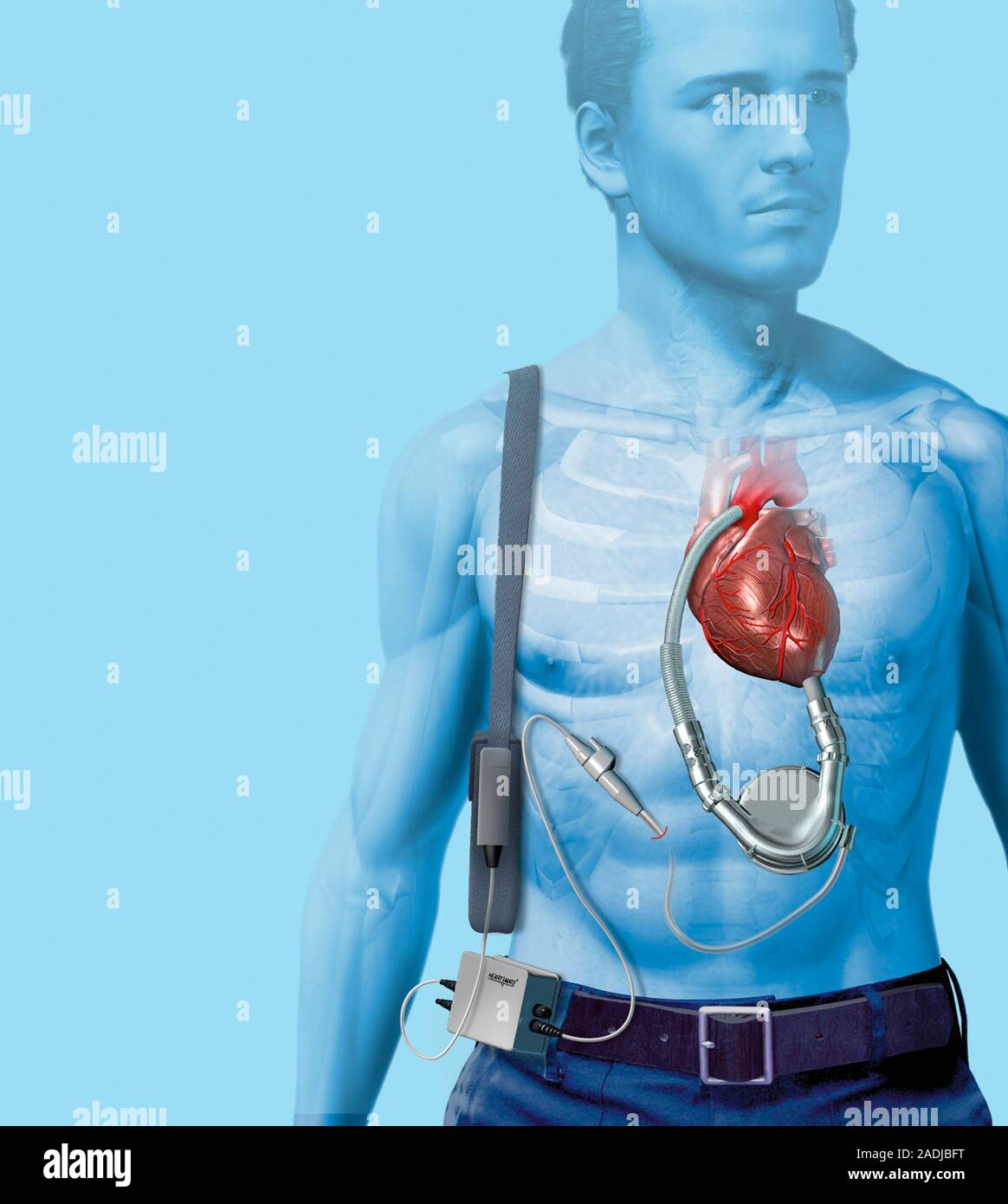 автономное искусственное сердце abiocor. сердце. первые искусственные органы. искусственное сердце abiocor (2001). первые искусственные органы.