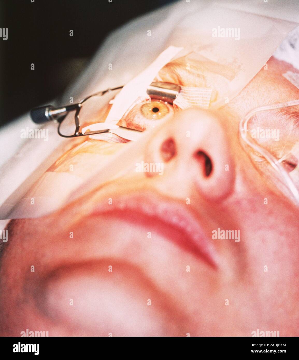 Eye surgery. Image 1 of 3. During the operation the eye is held open by