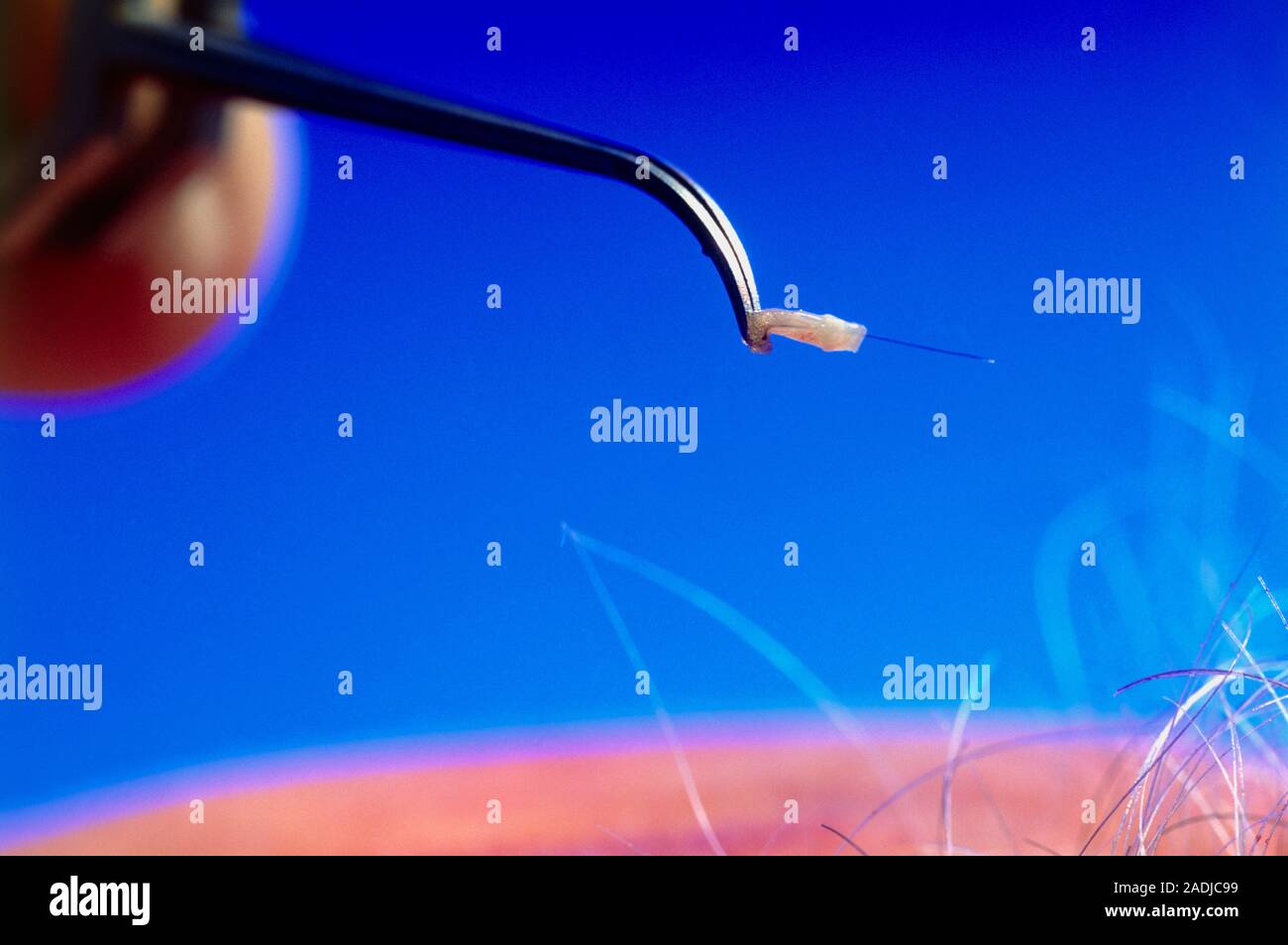 Hair transplant surgery. Image 6 of 9. Hair plug about to be inserted