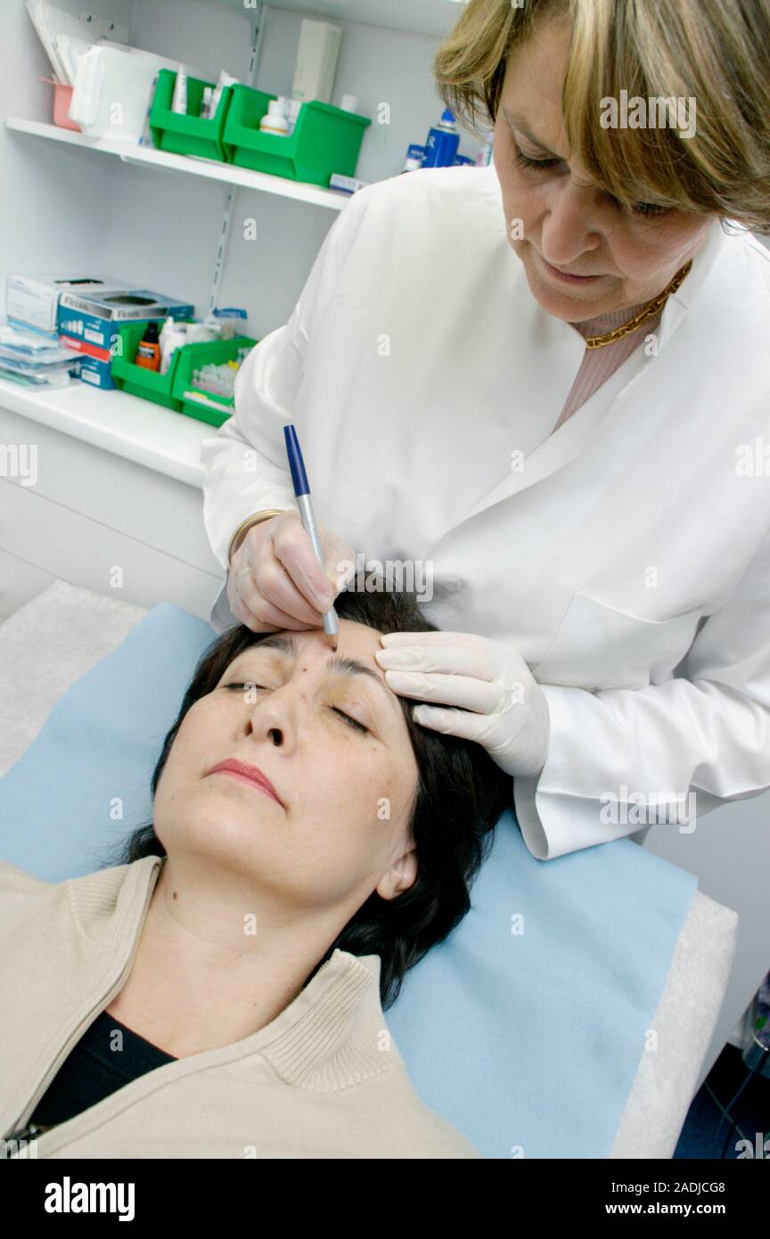 MODEL RELEASED. Botox treatment. Dermatologist marking a client's face ...