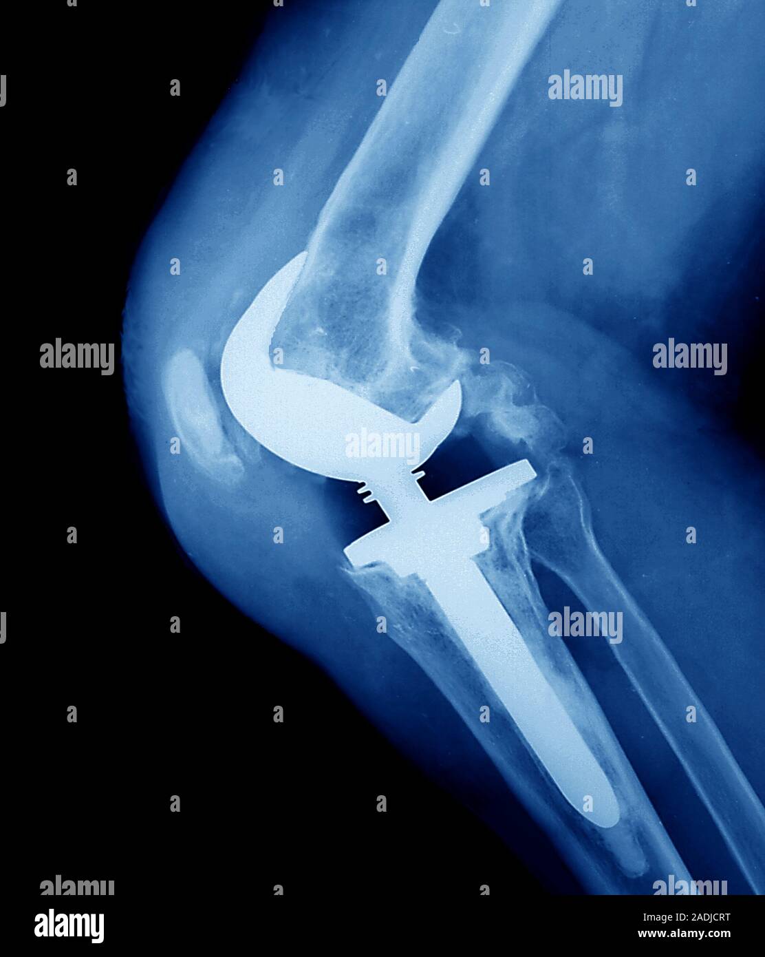 Knee replacement. Coloured Xray of the prosthetic knee (white), seen