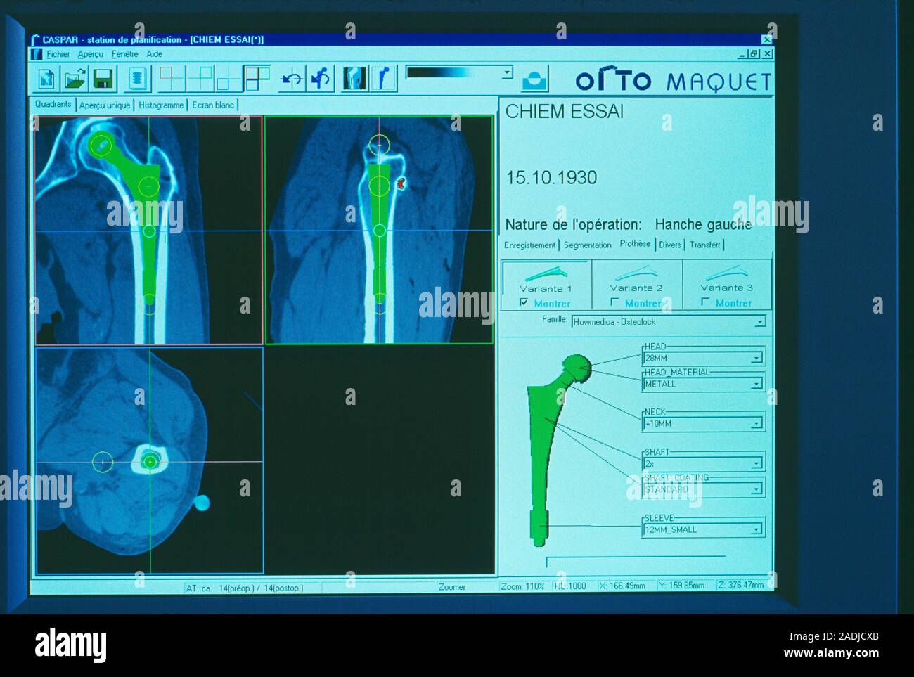 Computer-aided prosthesis selection. Screen showing computer modelling ...