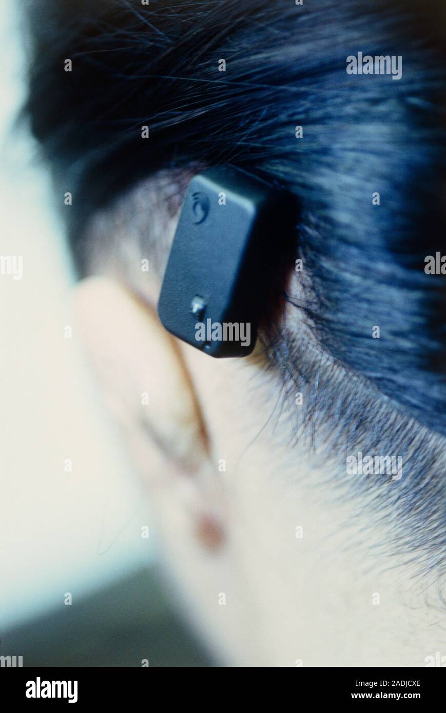 Hearing aid. Bone anchored hearing aid (BAHA) in place behind a person's ear. This system works
