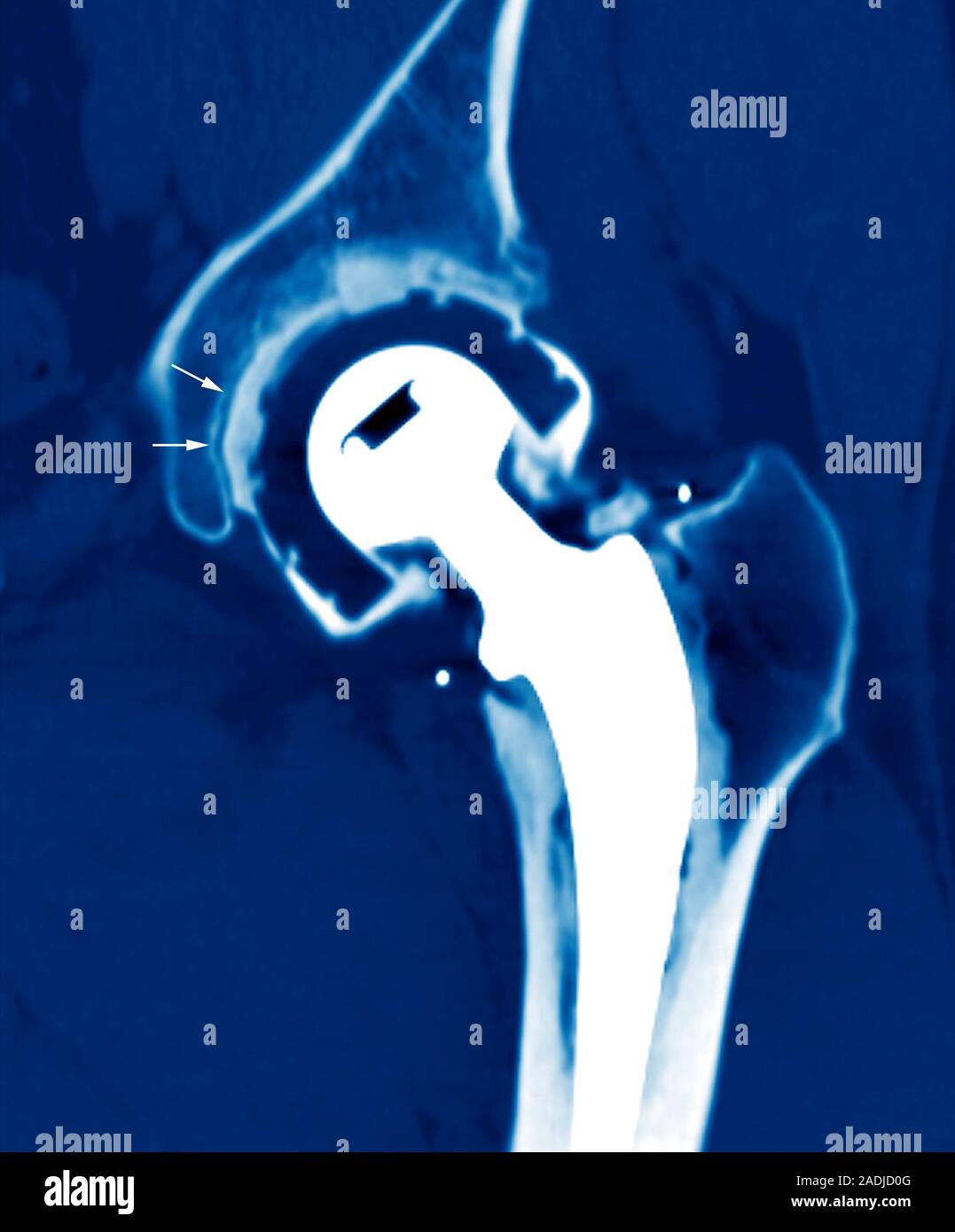 Loosened hip replacement. Coloured computed tomography (CT) scan of the ...