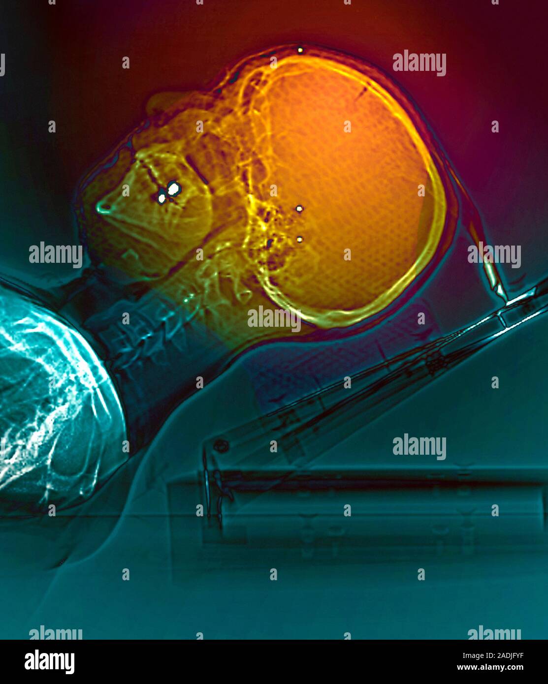 Radiotherapy For Brain Cancer Coloured Computed Tomography Ct Scan Of The Head Of A Patient 1077