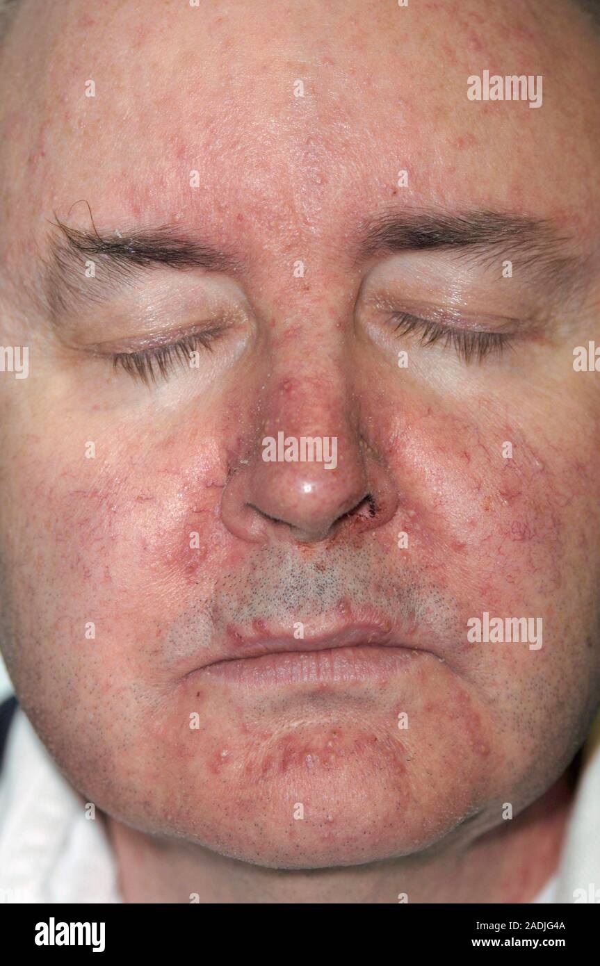 Skin rash following chemotherapy. The rash, seen on this 53yearold
