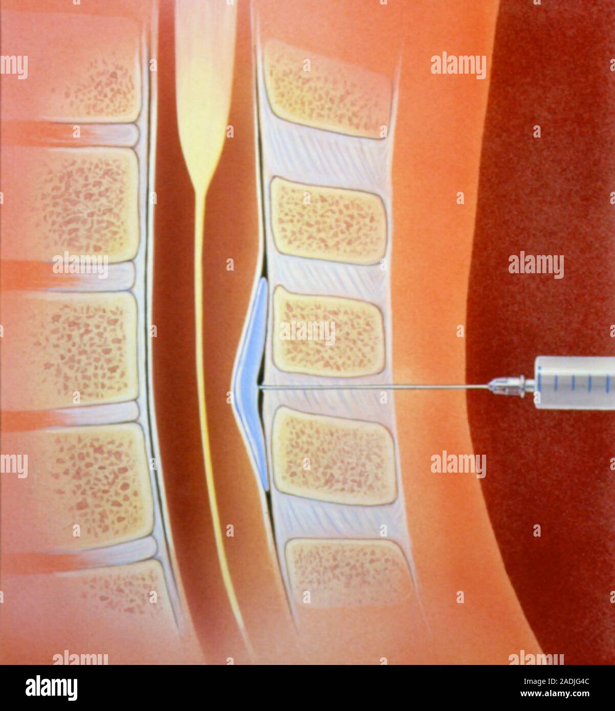 Illustration of the technique of giving a spinal epidural anaesthetic