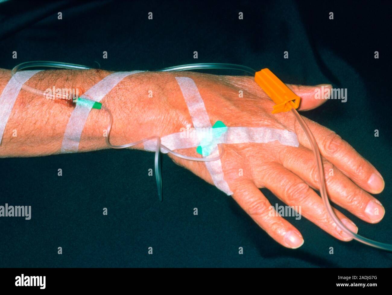 Immunoglobulin infusion. Close-up of the forearm of a 50-year-old man ...