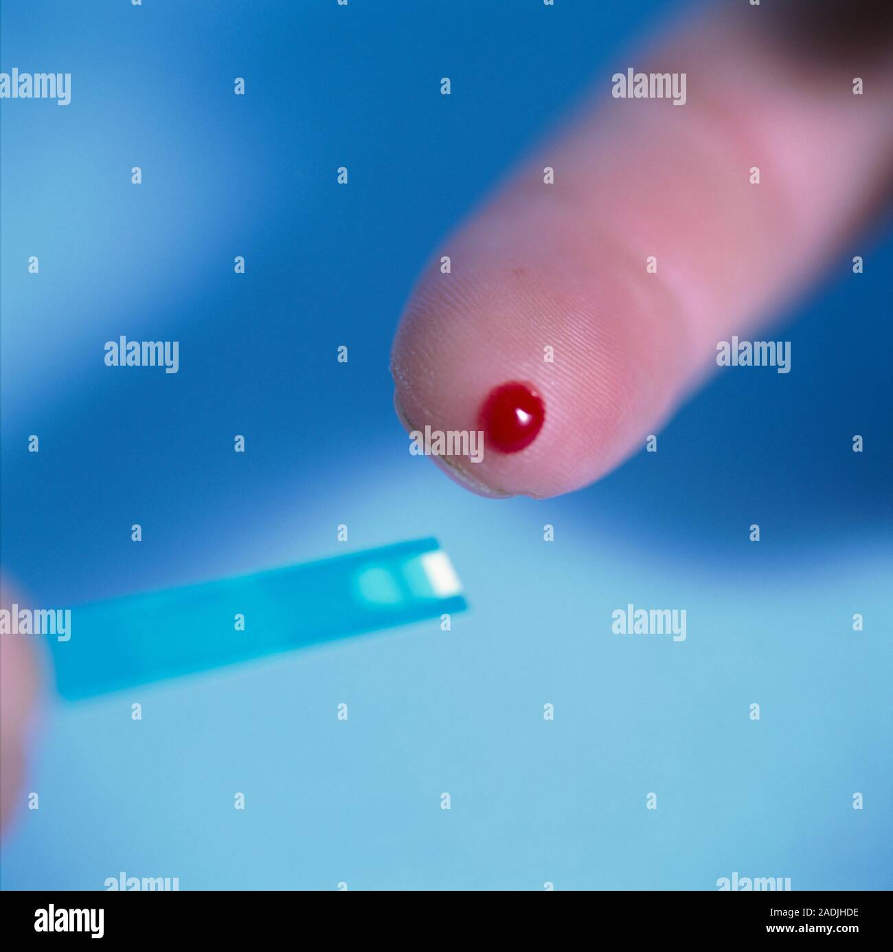 MODEL RELEASED. Diabetes mellitus is a carbohydrate metabolism disorder that results in