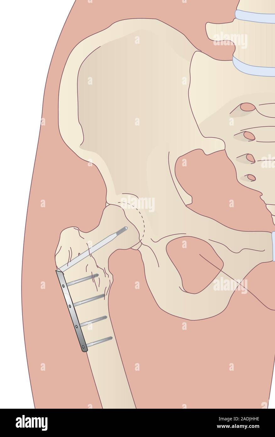 Pin Alignment Hip Pinned arthritic hip. Artwork of a hip with a pinned femur (thigh bone ...