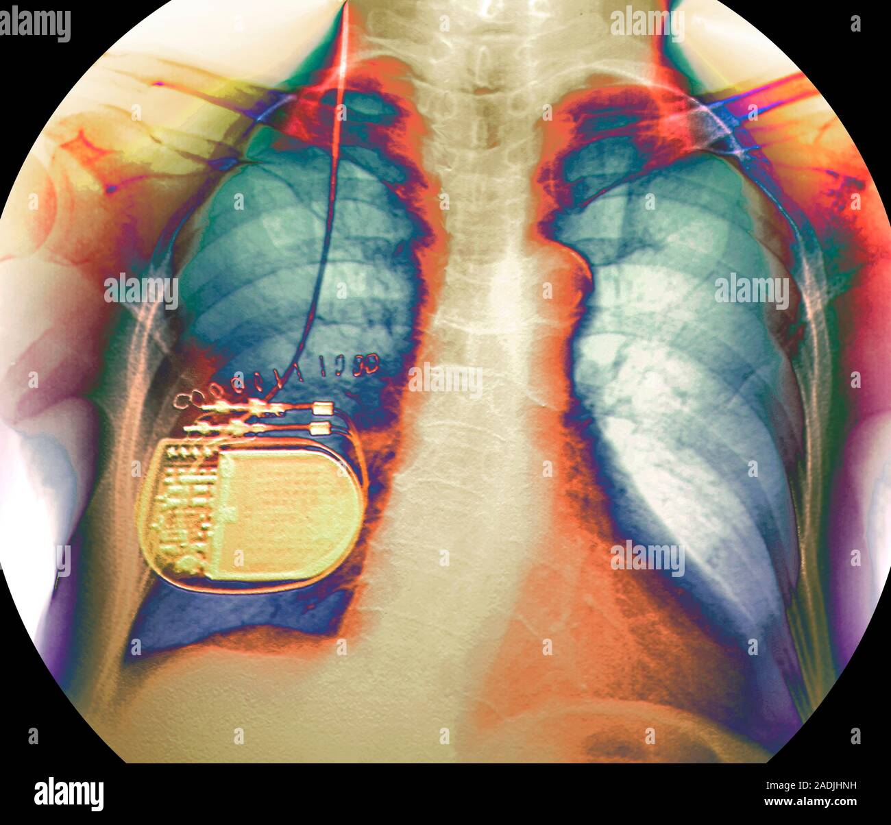 Parkinson's disease. Coloured Xray of a front view of the chest of a