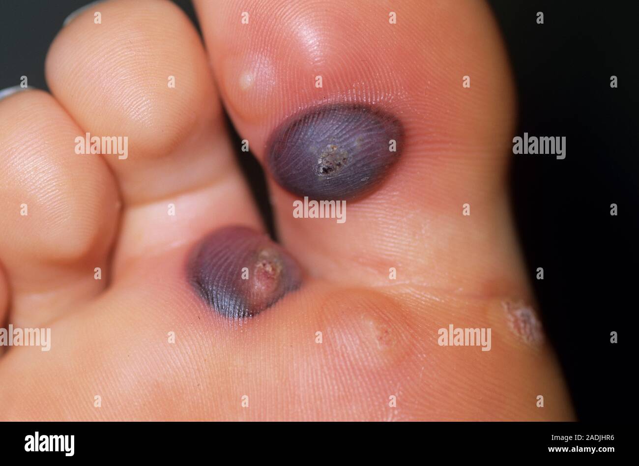 Verruca treatment. Blisters on the foot of a 22 year old woman after