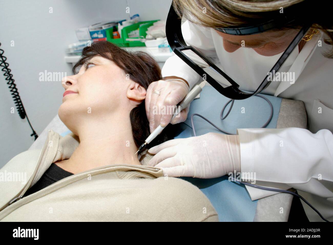 MODEL RELEASED. Electrolysis. Dermatologist carrying out short wave