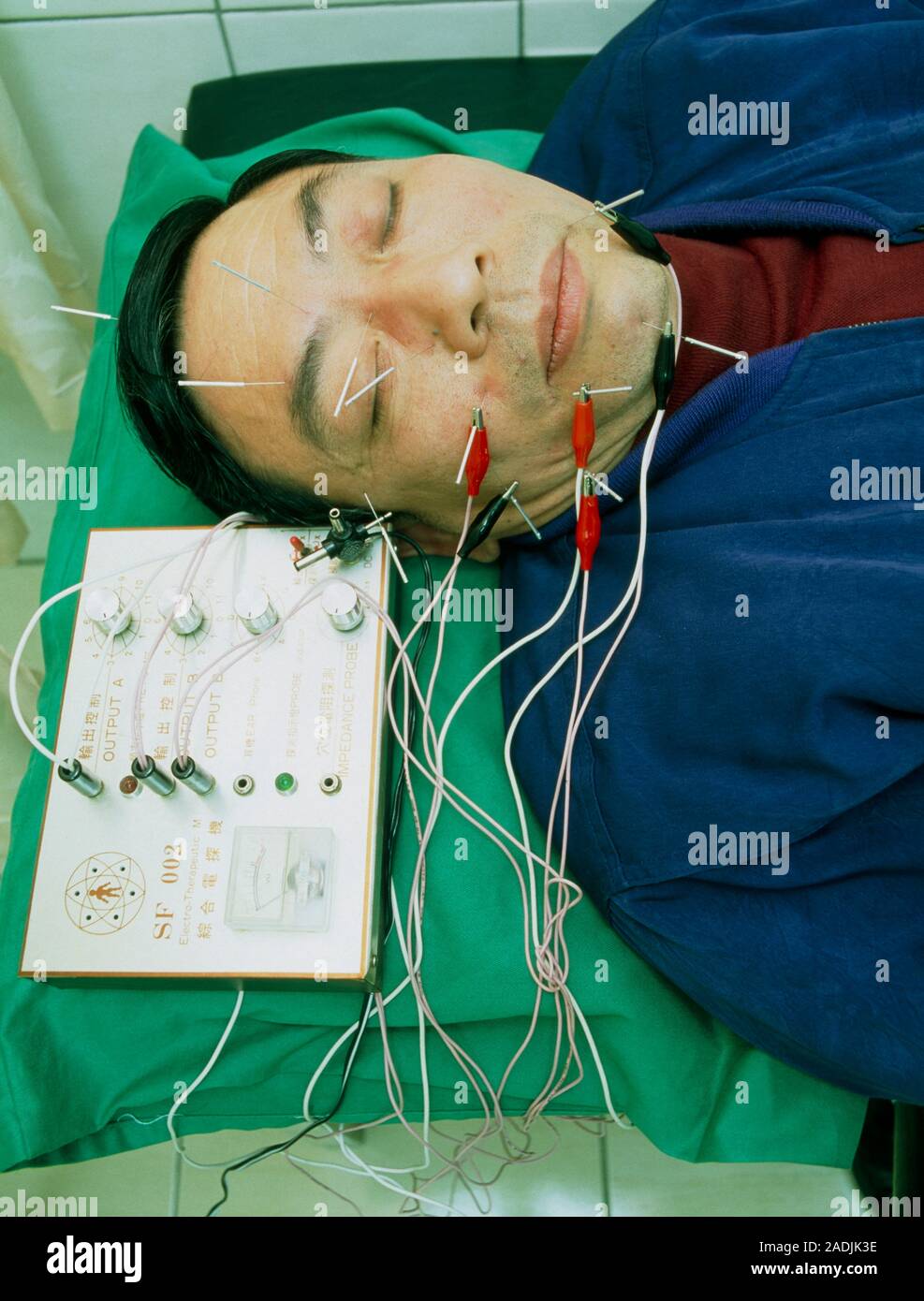 Electroacupuncture. Male patient receives electroacupuncture therapy
