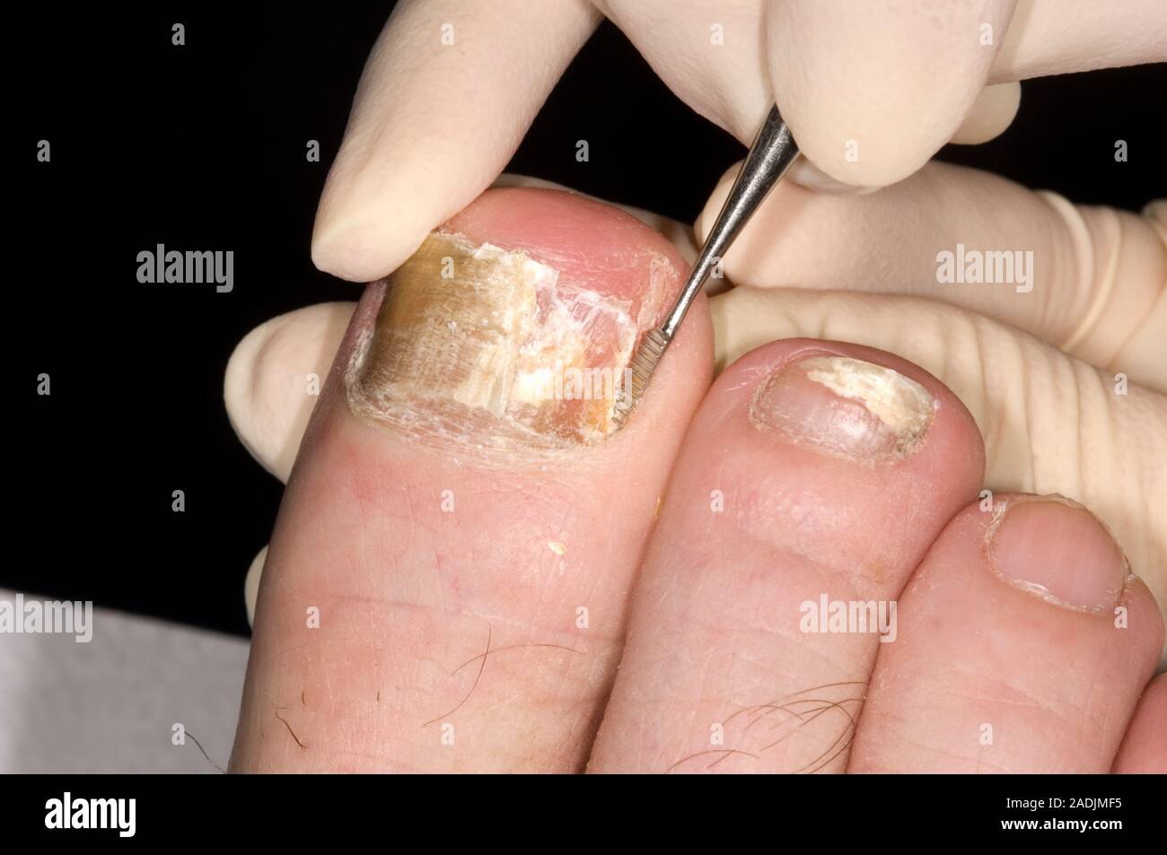 Fungal nail infection. Chiropodist removing dead tissue from a patient's toenail. The toenail