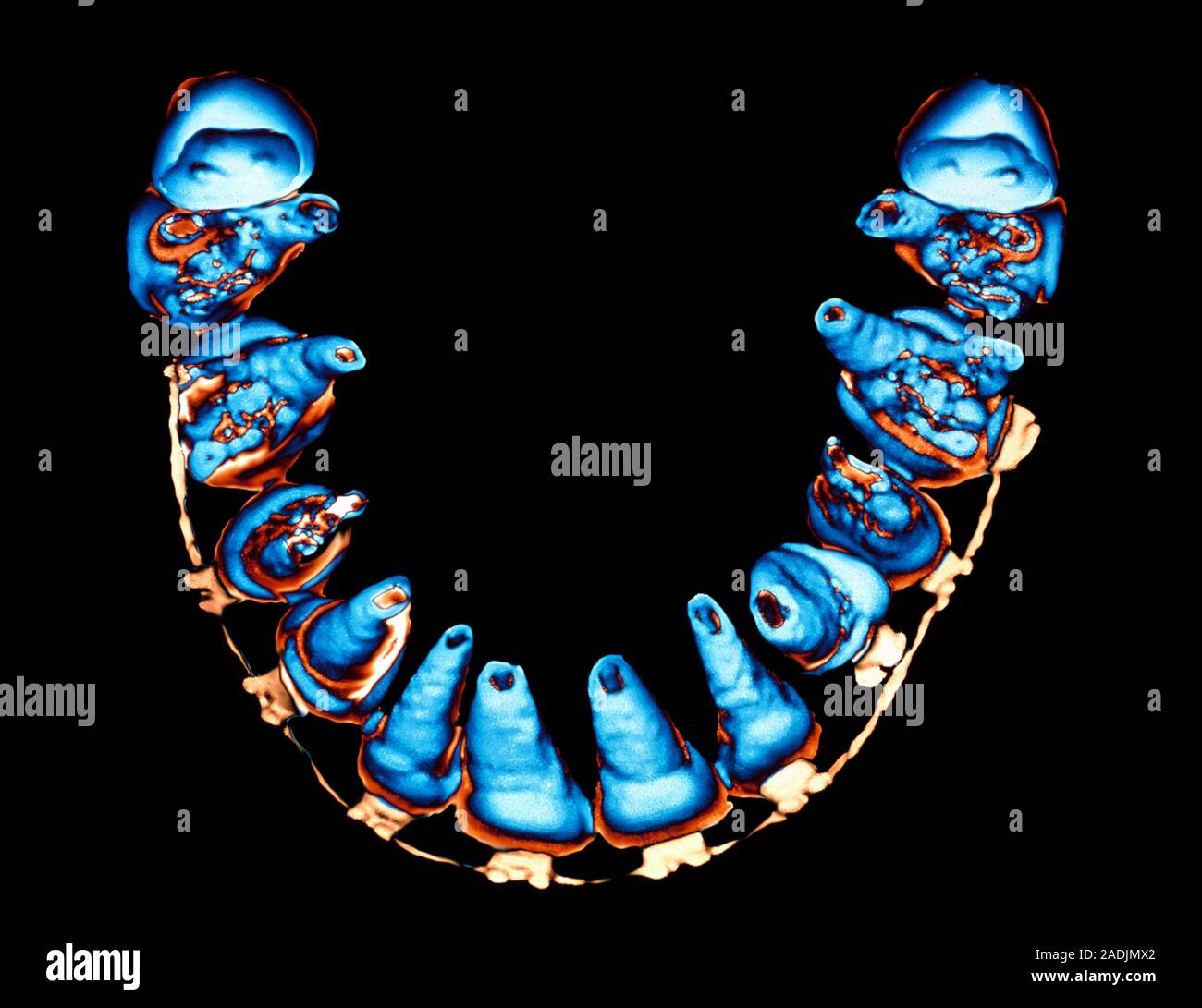 Orthodontic brace. Coloured three-dimensional computed tomography (CT ...