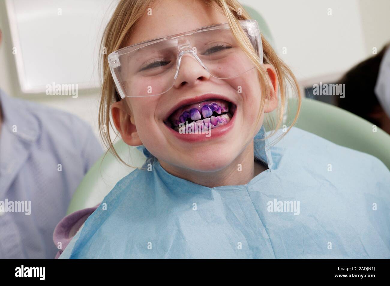 Plaque detection. Girl showing the plaque on her teeth revealed by a disclosing tablet. The tablet contains a dye that binds to plaque when the tablet Stock Photo