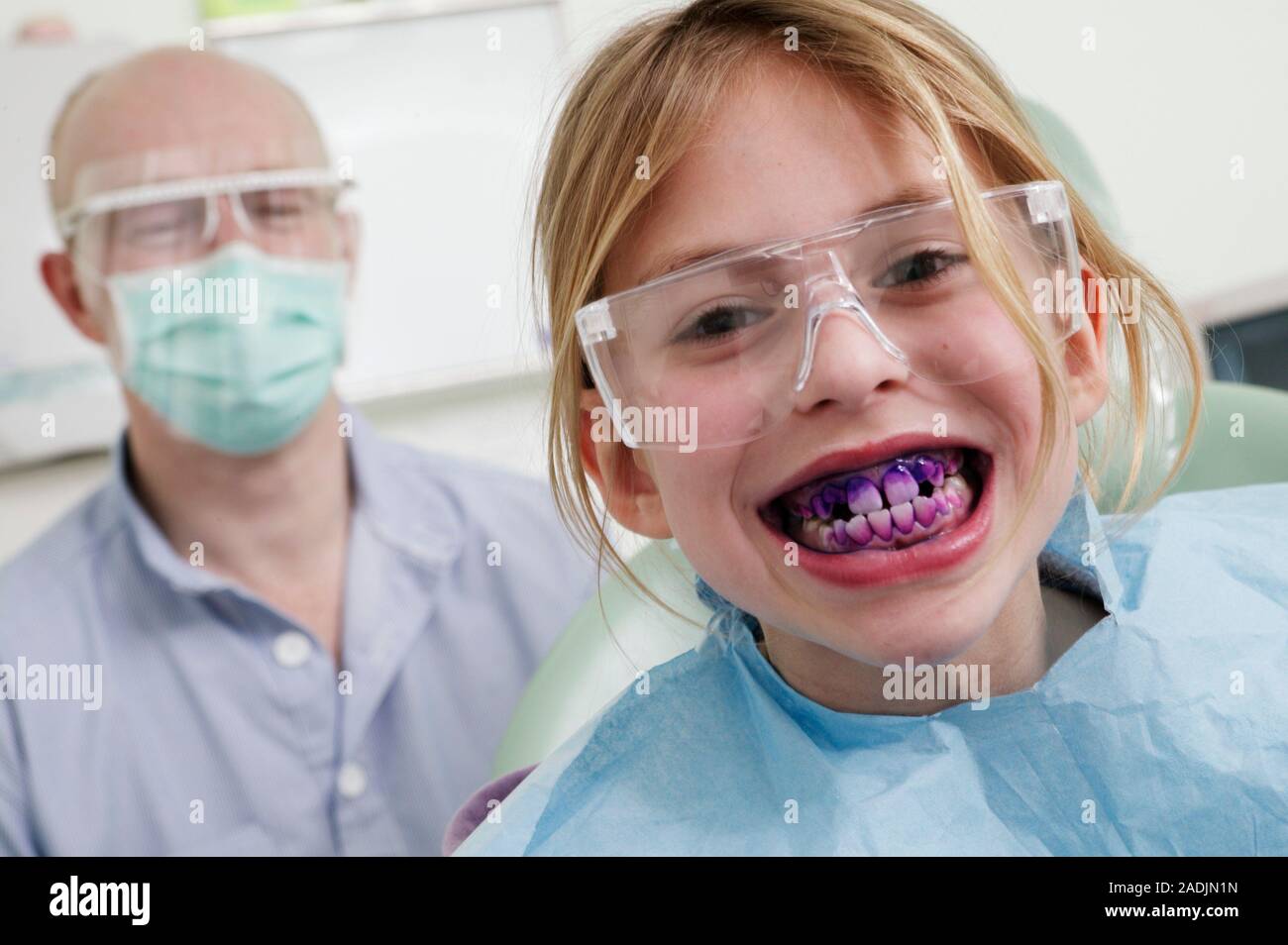 Plaque detection. Girl showing the plaque on her teeth revealed by a