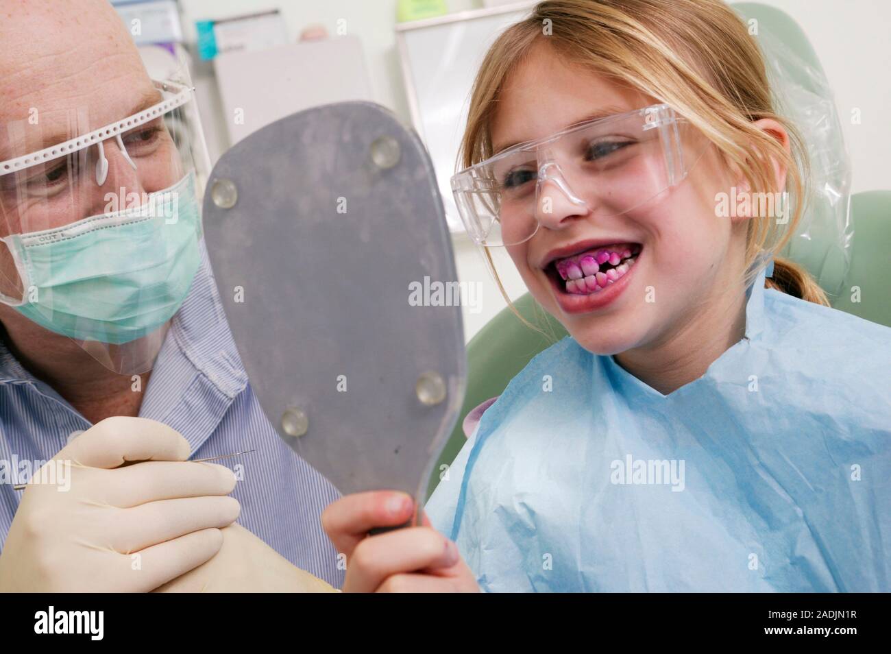 Plaque detection. Girl looking in a mirror after using a plaque disclosing tablets to show up areas of plaque on her teeth. A dentist is standing next Stock Photo