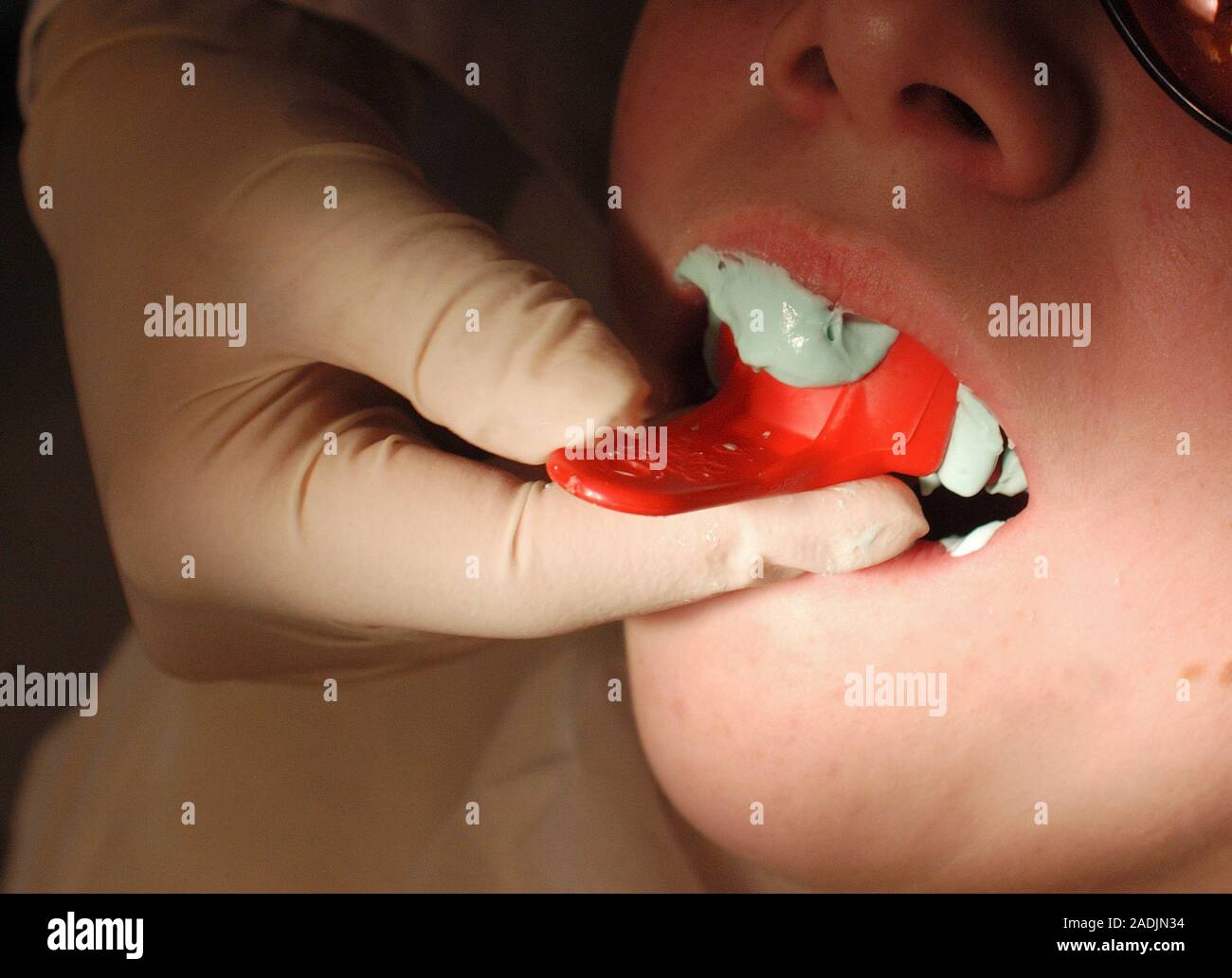 Dental impression. Dentist taking an impression of a young patient's