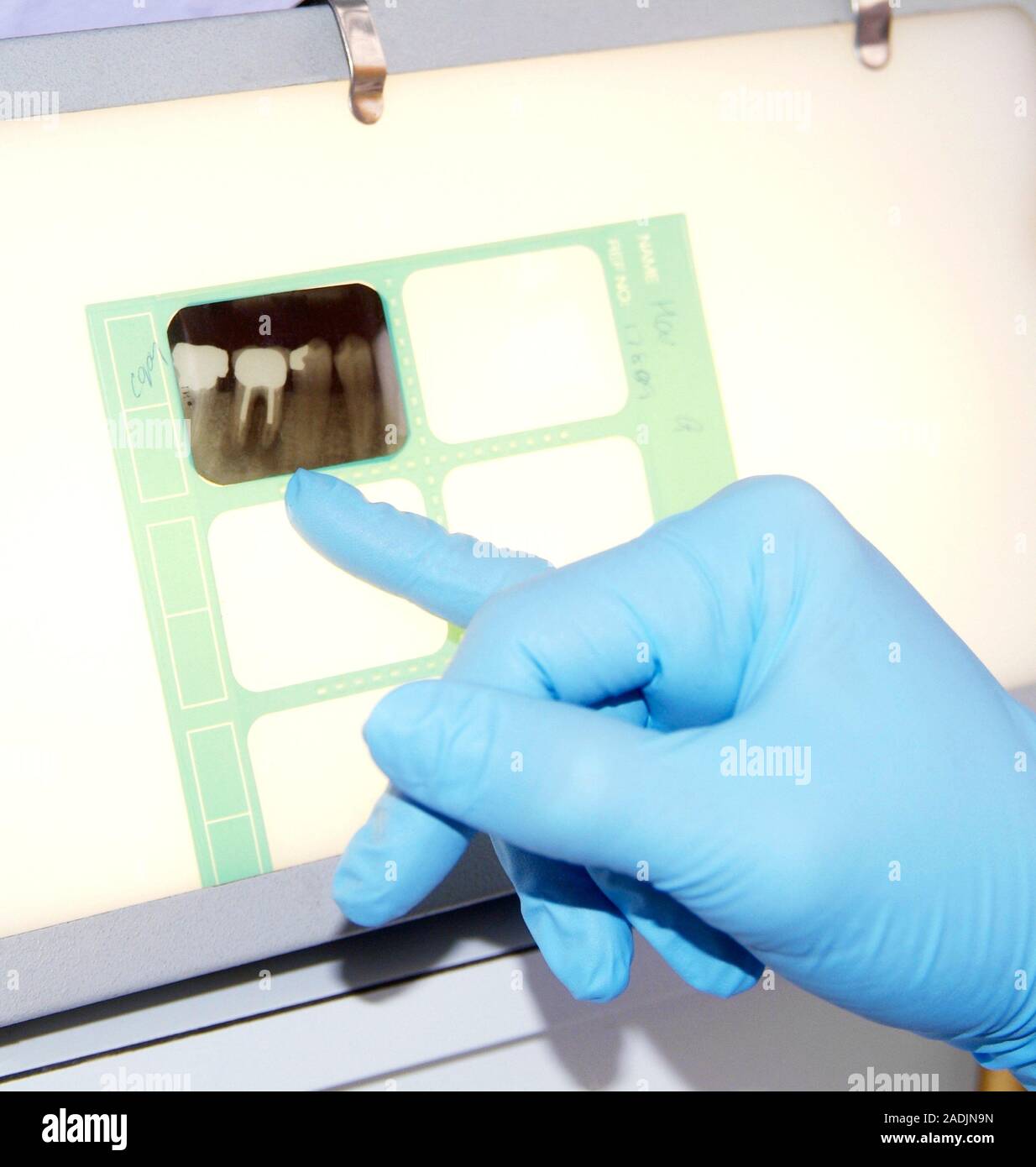 Dental Xray. Dentist examining an Xray of a patient's teeth. The