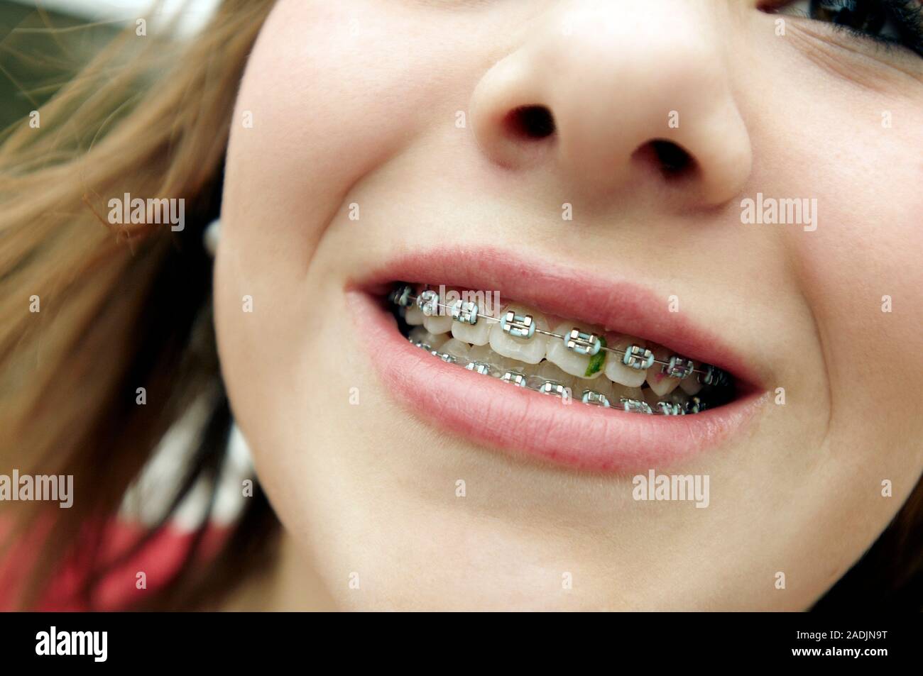 можно ли есть шоколад с брекетами