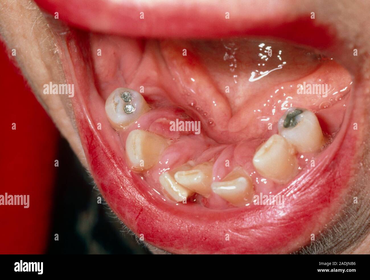 Gingivitis. Closeup of swollen, inflamed receding gums around uneven teeth in the lower jaw