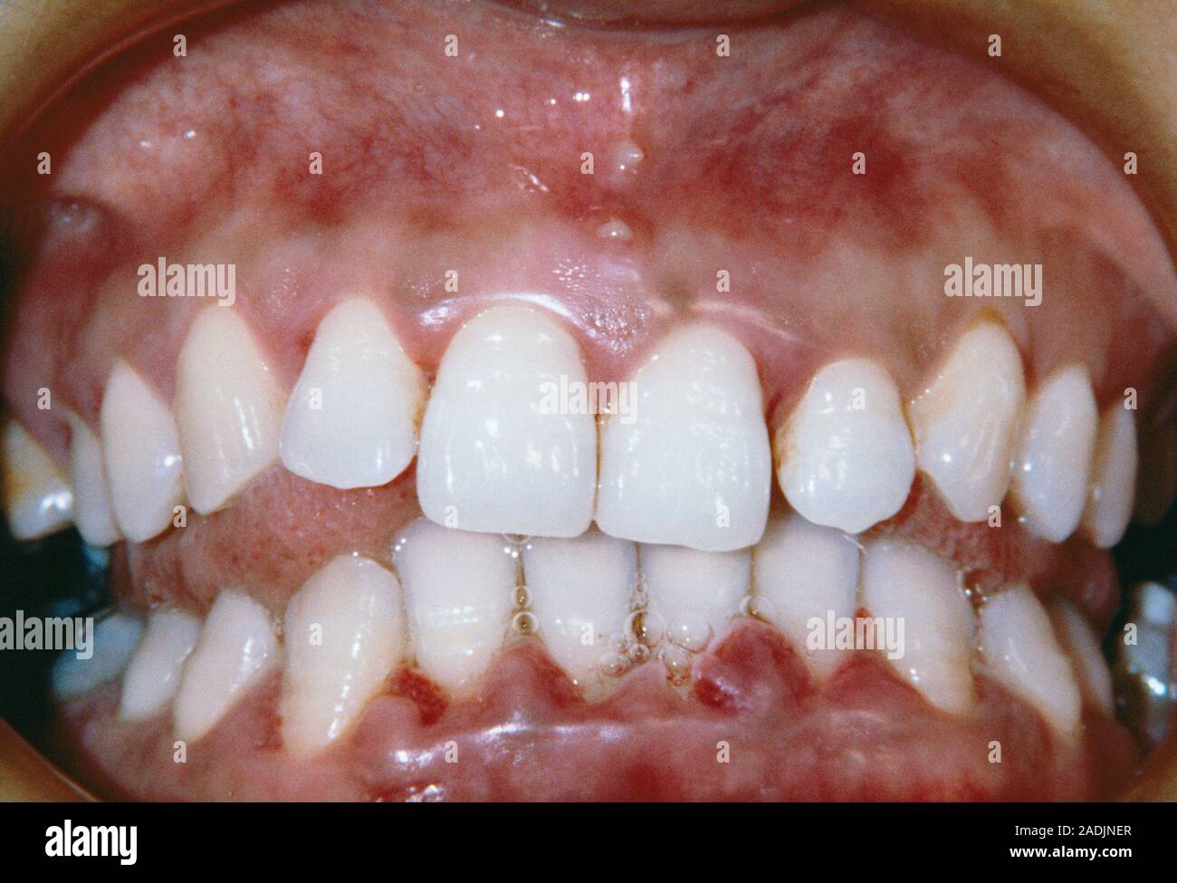 Gingivitis. Inflamed gums of a patient suffering from gingivitis. Several ulcers are seen at the
