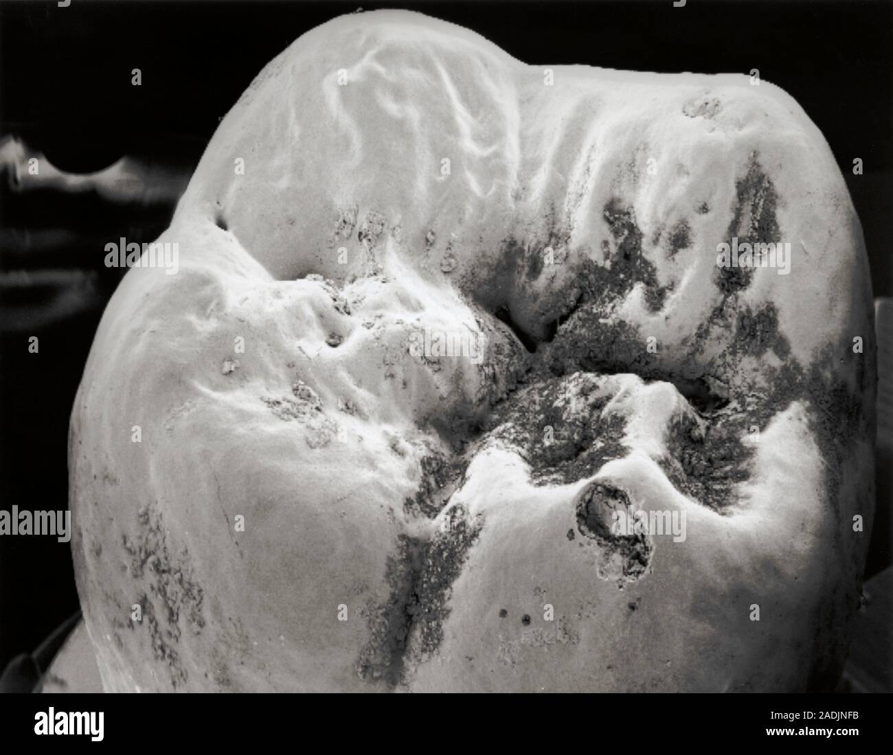 Tooth decay. Scanning electron micrograph (SEM) of the surface of a ...