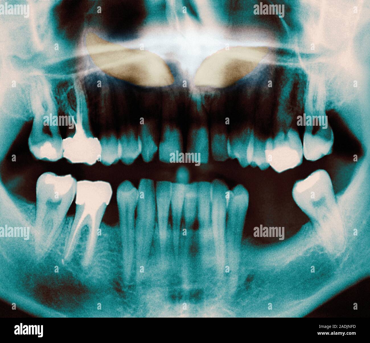 Impacted incisors. Coloured dental Xray of impacted incisors (yellow). Impacted teeth are those