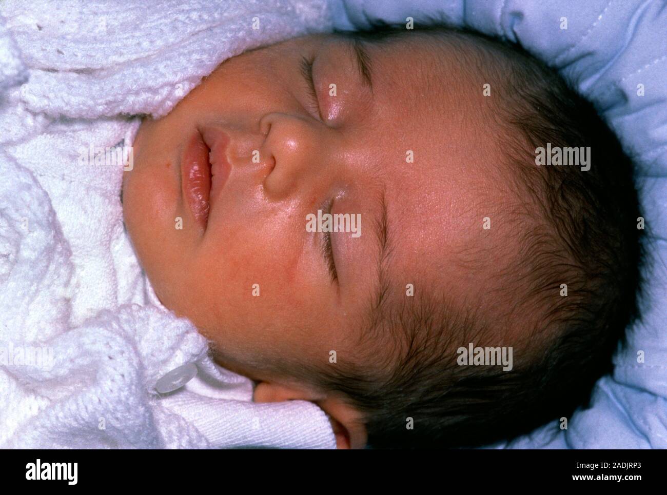 Neonatal jaundice. The face of a 3weekold baby with jaundice