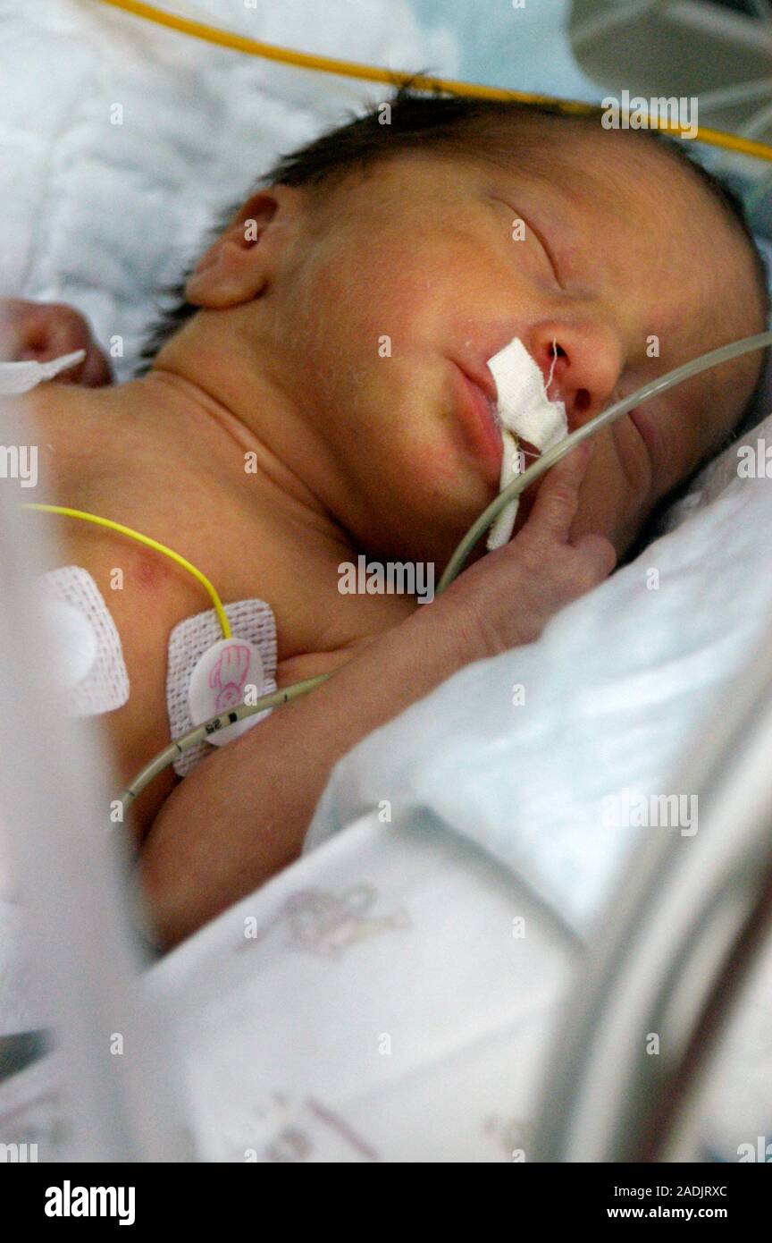 Jaundiced premature baby sleeping. Jaundice is a yellow discolouration