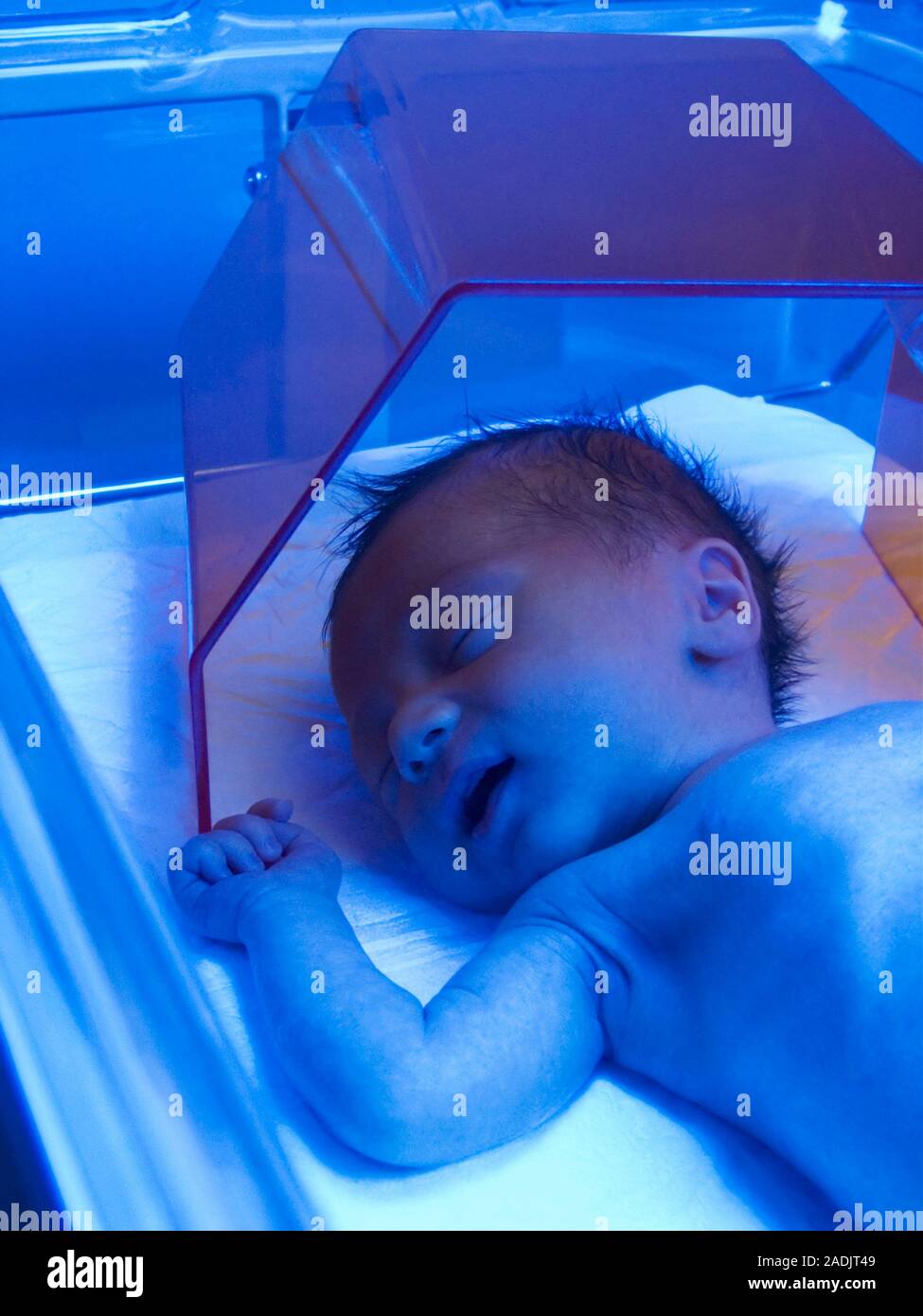 Neonatal jaundice treatment. Baby in an incubator receiving blue light phototherapy to treat