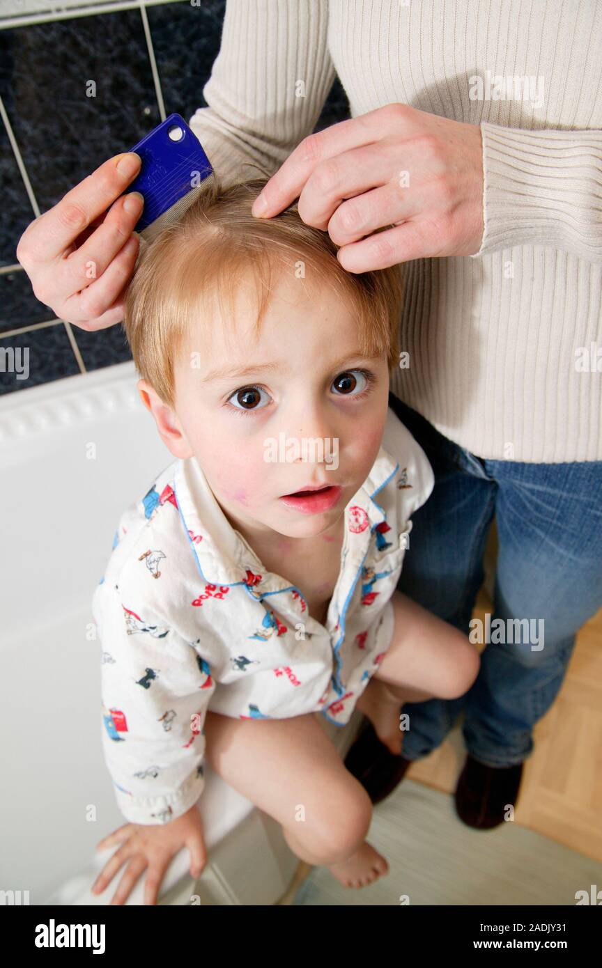 Head lice combing. Special comb being used by a mother to remove dead