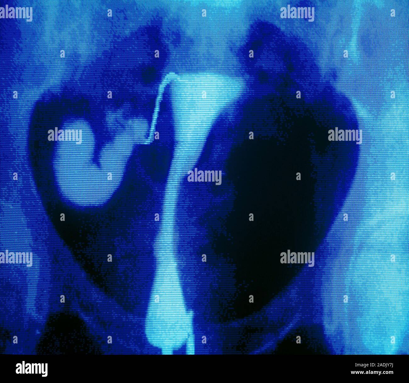 Infertility falsecolour hysterosalpingogram of the abdomen of a woman