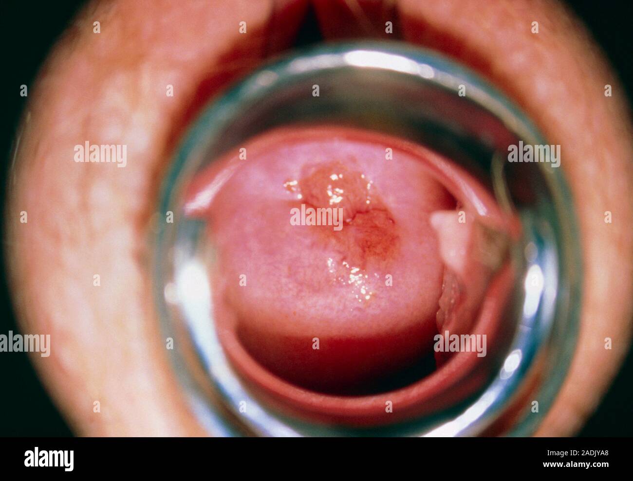 Cervical dysplasia CIN 1. Colposcopy of a cervix (centre) with CIN 1  dysplasia. This is the first stage in the possible development of cervical  cancer Stock Photo - Alamy