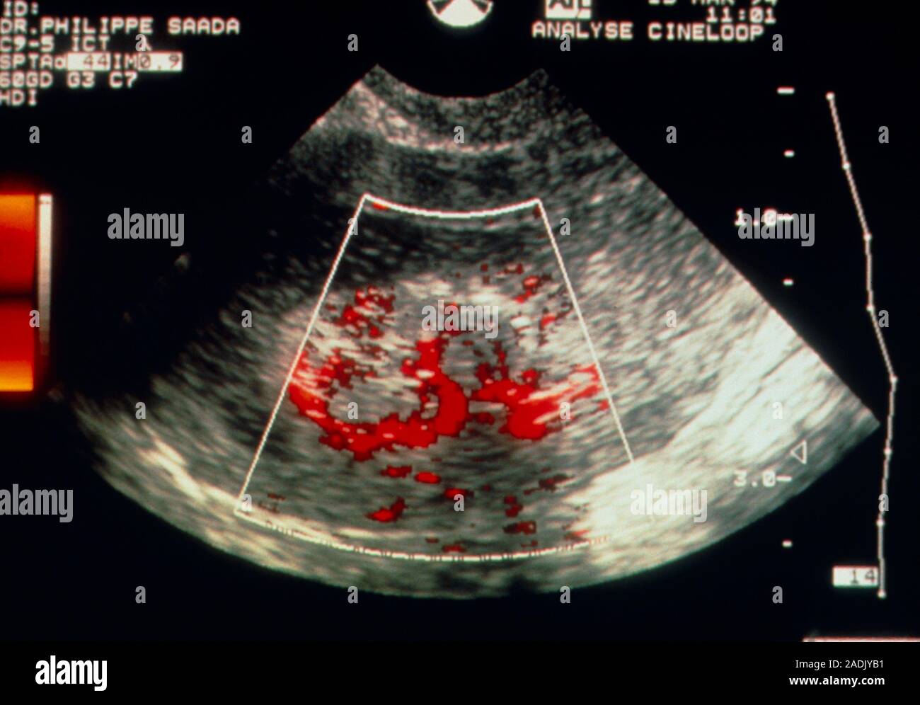 Gynecology Ultrasound Report